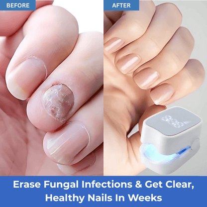 NailCure Pro™